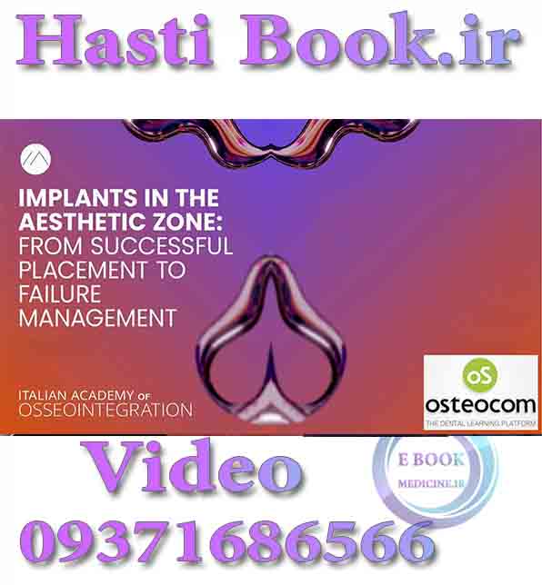 فیلم Osteocom Implants in the Aesthetic Zonefrom  Successful Placement to Failure Management (2)