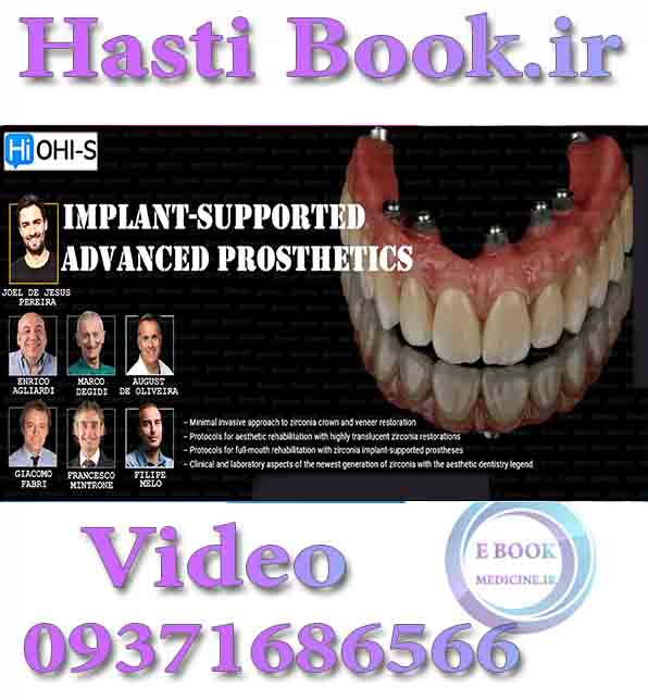 فیلم OHI-S Implant-Supported Advanced Prosthesis video(2)