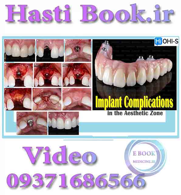 فیلم OHI-S Implant Complications in the Aesthetic Zone video (2)