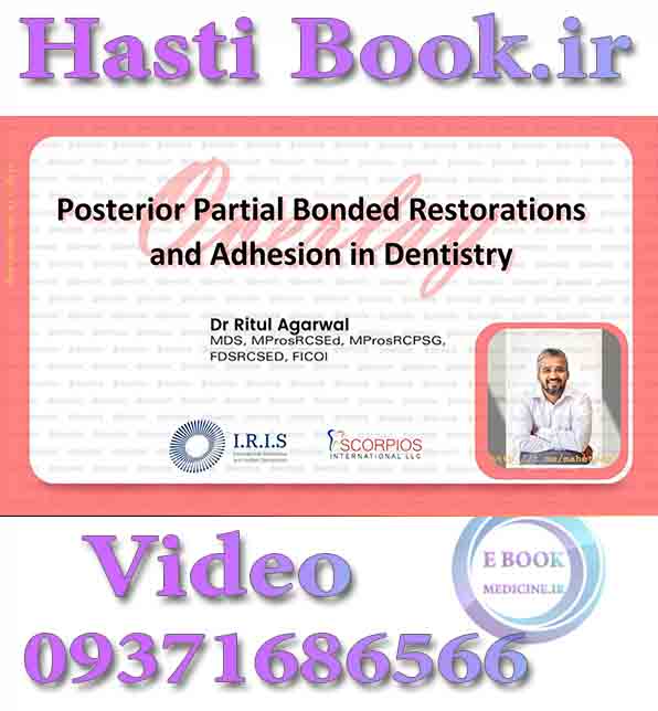 فیلم IRIS Posterior Partial Bonded Restorations and Adhesion in Dentistry (Overlay) - Ritul Agarwal video (2)