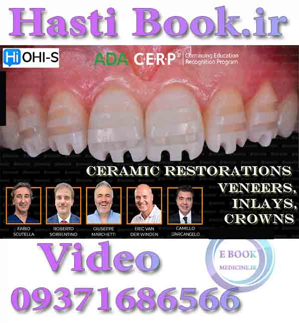 فیلم OHI-S Ceramic Restorations Veneers, Inlays, Crowns video (2)